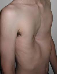 Check spelling or type a new query. Pectus Excavatum Wikipedia