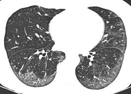 Compare all options and book direct with delta & american with no hidden fees. Pneumonie Interstitielle Non Specifique Troubles Pulmonaires Edition Professionnelle Du Manuel Msd