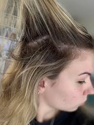 Hair loss during first trimester of pregnancy?