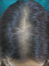 According to the american hair loss association only 2 to 5 percent of women are candidates for hair transplants. Indian Journal Of Dermatology Venereology And Leprology Female Pattern Hair Loss