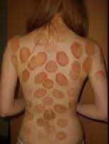 A lot of it depends on the color of the marks. Frequently Asked Questions About Cupping Balance Acupuncture Massage