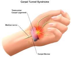 Carpal Tunnel Syndrome Fit For Life Wellness Clinic