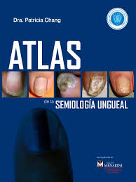 Se produce por traumatismos en la matriz de la uña y factores genéticos. Atlas De La Semiologia Ungueal Clavo Anatomia Sistema Tegumentario