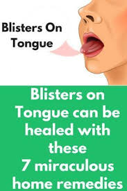 Blisters On Tongue Can Be Healed With These 7 Miraculous Home Remedies In 2020 With Images Sore In Mouth Remedies Tongue Sores Blister On Tongue