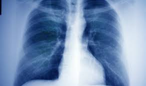 Legene tror at sveden har spist en ert, men at det på mysterisk vis har klart å komme ned feil vei og begynte å gro i lungene. Lungekreft