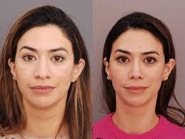 UK's Leading Rhinoplasty Surgeon │ Charles East