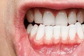 When it comes to keeping our gums healthy there are a few things that you should be doing. 6 Ways To Keep Your Gums Healthy Community Health Of Central Washington