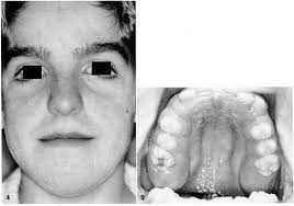 Hereditary gingival fibromatosis with a recessive mode of inheritance. Case  reports