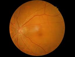 Cancela sin cargo casi siempre. Macular Degeneration Optometrist In Jonesboro Ar Fletcher Family Eyecare