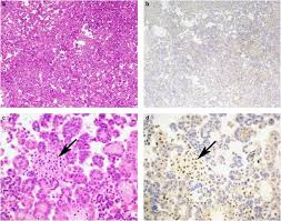 Check spelling or type a new query. Loss Of Expression Of Bap1 Is A Useful Adjunct Which Strongly Supports The Diagnosis Of Mesothelioma In Effusion Cytology Modern Pathology