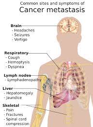But sometimes cancers can be tender, soft, and rounded. Cancer Signs And Symptoms Wikipedia
