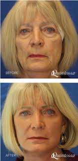 Facelift Surgery Near Milwaukee Madison Quintessa Face Lift Surgery Facial Skin Facial Fillers