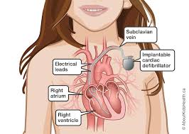 Congestive Heart Failure