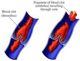 Superficial Blood Clots May Be Warning Sign Study Reuters