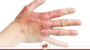Image result for dermatitis contacta