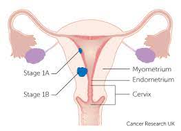 Symptoms of womb cancer the most common symptom of womb cancer is vaginal bleeding that is unusual for you (abnormal). Endometrial Cancer Uterine Nzgcf