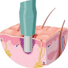 Skin Biopsy
