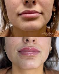 Fall in love with your lips this season 🍂💄 Immediate results Bruising and  swelling is normal following the procedure and can last up to 7 days •  #lipfiller #lips #aestheticnurse #botox #before #
