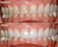 This Patient Had Severe Yellowing Of Her Teeth And Degradation Of Enamel Veneers Have Given Her A Beautiful Wh Dental Implants Dental Treatment Dental Tourism