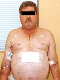 Thymic Neuroendocrine Carcinoma Producing Ectopic Adrenocorticotropic Hormone And Cushing S Syndrome The Annals Of Thoracic Surgery
