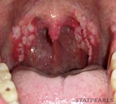 Image result for Tonsillitis