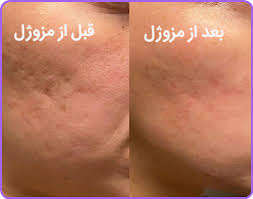 مزوژل