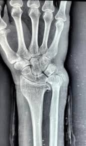Ulnar Impaction Syndrome With Positive Variance >4 Mm | Download Scientific  Diagram” style=”width: 100%; height: auto; title=”Ulnar Impaction Syndrome With Positive Variance >4 Mm | Download Scientific  Diagram”><figcaption style=
