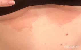 Image result for Candidiasis under breasts