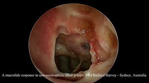 These polyps usually occur in both the right and left nasal passages and obstruct the flow of air. Modern Treatment For Nasal Polyps And Sinusitis