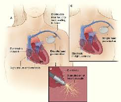 Pacemaker for iphone, ipad and apple watch. Pacemaker Implantation In Germany