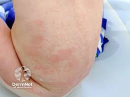Image result for Rubella