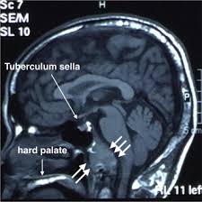 During his conversation with tert.am, slavmed medical center's endocrinologist vahe avagyan described the main types of thyroid disease in detail, its symptoms, and when one. Intracranial Metastasis Of Follicular Thyroid Carcinoma Mimicking Cerebellopontine Angle Tumour Sciencedirect