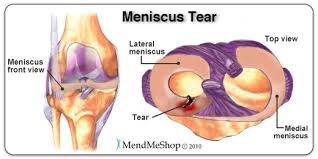 Wear good shoes, run on softer grounds (e.g. Meniscus Tear Diagnosis