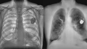 Image result for lung cancer xray