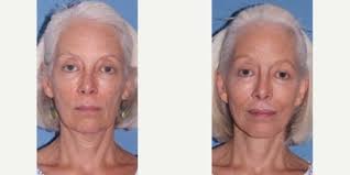 T. Gerald O`Daniel, MD, Board Certified Plastic Surgeon