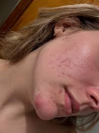 What are some good aestheticians or facialists in San Diego for pore help  and anti-aging?