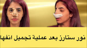 الإحساس بألمٍ شديد في مكان إجراء العملية، والذي قد يستمر لبضعة أسابيع. Ù†ÙˆØ±Ø© Ø§Ù„Ø¹Ù…ÙŠØ±ÙŠ Ø¨Ø¹Ø¯ Ø¹Ù…Ù„ÙŠØ© Ø§Ù„ØªØ¬Ù…ÙŠÙ„