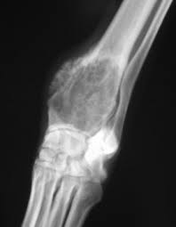 Image result for Osteosarcoma