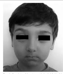 Aplasia of the mandibular condyle associated with some orthopaedic  abnormalities.