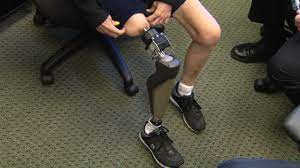 A giant step forward in artificial legs - CBS News