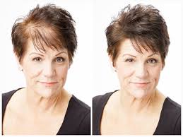 Noticeable hair loss in women can be deeply distressing. Hair Loss Solution For Women