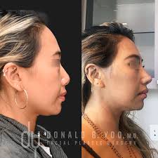 Donald B. Yoo MD, FACS (@asianrhinoplasty) • Threads, Say more