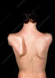 Image result for Winged Scapula