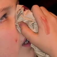 Misalnya, ketika orang tua berdarah paling sering menggunakan kapas, dipasang di bagian hidung, untuk menghentikan. Anak Kecil Kok Sering Mimisan