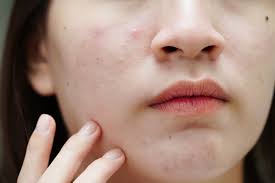 Image result for acne face
