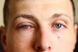 Image result for Allergic Conjunctivitis