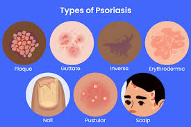 Image result for psoriasis