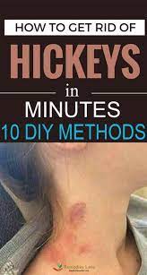 How can you cover a hickey effectively? Pin On Home Beauty Tips