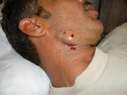 Deep ingrown hair is when the hair follicle curls deeper in the skin and start growing deeper inwards instead of out the skin. 4 Tips To Treat And Avoid Ingrown Hairs Exfoliating Removing The Upper Layers Of Dead Skin Is In Ingrown Facial Hair Infected Ingrown Hair Ingrown Hair Cyst