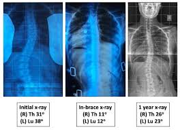 Bracing In The Treatment Of Adolescent Idiopathic Scoliosis Evidence Ahmt